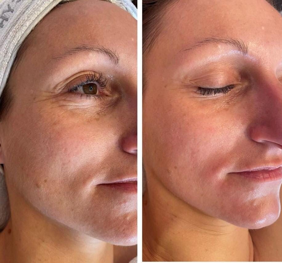 Résultat avant / après sur les ridules du contour de l'œil, soin du visage à l'institut Secrets de Beauté Marie-Fleur, Rochefort-du-Gard