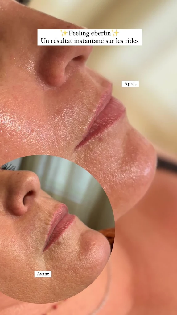 Peeling Eberlin — résultat avant / après sur les rides, soin du visage à l'institut Secrets de Beauté Marie-Fleur, Rochefort-du-Gard